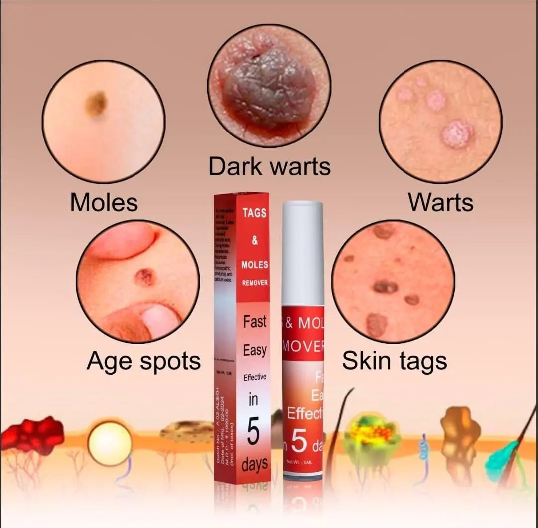LOVILDS™ Tags & Moles Remover (Buy 1 Get 1 Free🔥🔥)